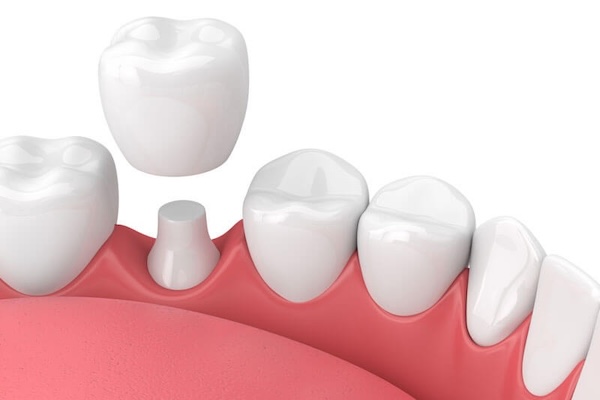 Cerec crowns